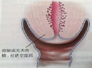 宮頸癌篩查沒那么簡單，這些技巧助你提高取樣質(zhì)量